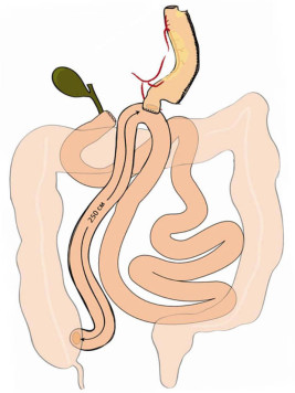 Лапароскопическое дуоденоеюнальное шунтирование (операция SADI) 