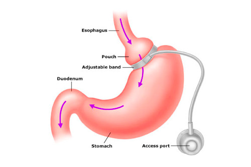Лапароскопическое бандажирование желудка 
