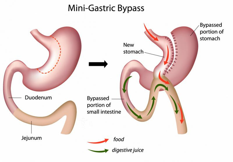 Лапароскопическое мини-гастрошунтирование 
