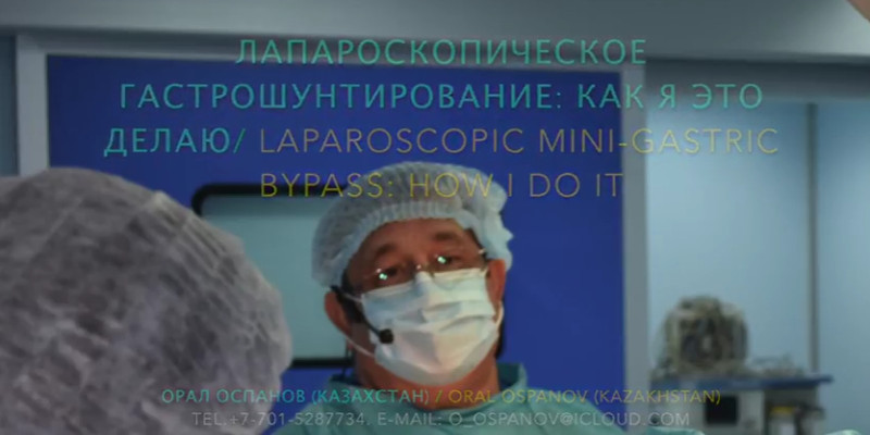 Laparoscopic Mini Gastric Bypass. Лапароскопическое Мини-гастрошунтирование