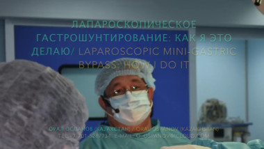 Laparoscopic Mini Gastric Bypass. Лапароскопическое Мини-гастрошунтирование