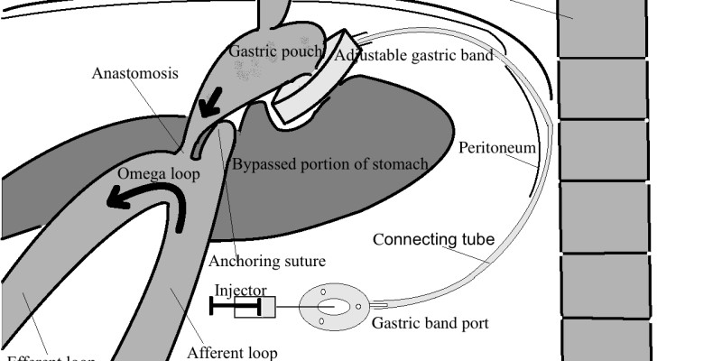 Trial to assess laparoscopic band-separated MGB Trial to assess laparoscopic band-separated MGB