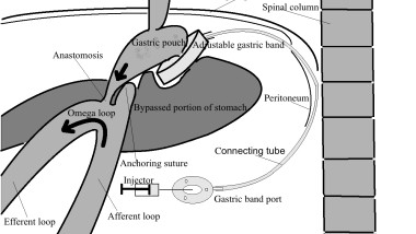 Trial to assess laparoscopic band-separated MGB